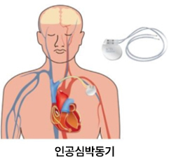 인공심박동기