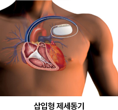 삽입형 제세동기