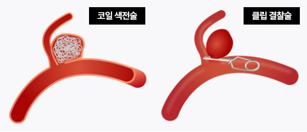 뇌혈관 개두술/색전술